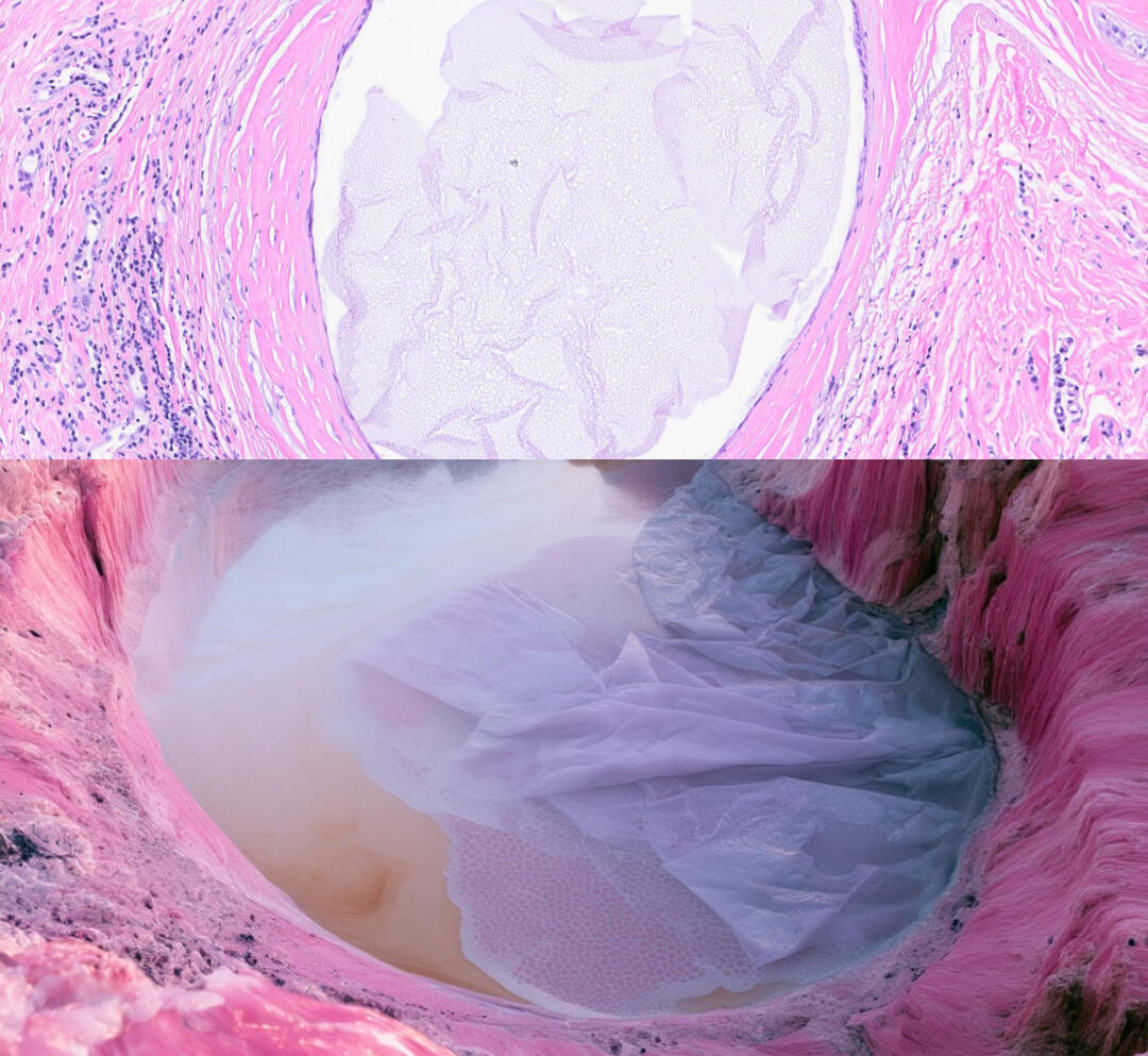 Specimen 078, Breast Skin Cyst: H&E microscopy paired with a cinematic pale lavender cyst-fluid lake surrounded by pink and violet biological terrain.
